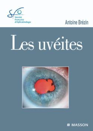 Les uvéites - Société française d'ophtalmologie