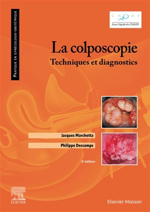 La colposcopie : techniques et diagnostics - Jacques Marchetta